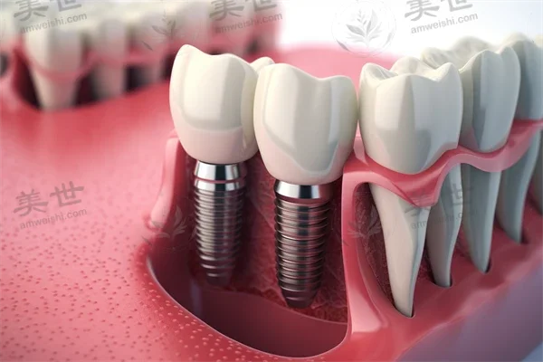 佛山中益口腔门诊的真实评价与2026年私立口腔医院排名，了解哪家更适合你