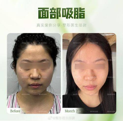 郑泰成医生技术优势