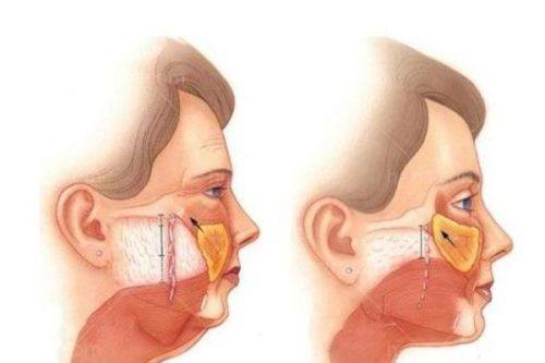 五、热敷的局限性：真性问题需专精医美干预