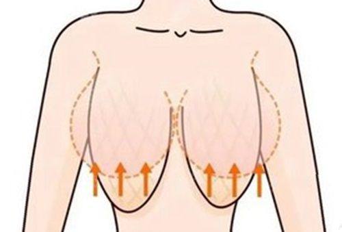 二、手术类祛眼袋：中重度眼袋的“长效良好解”