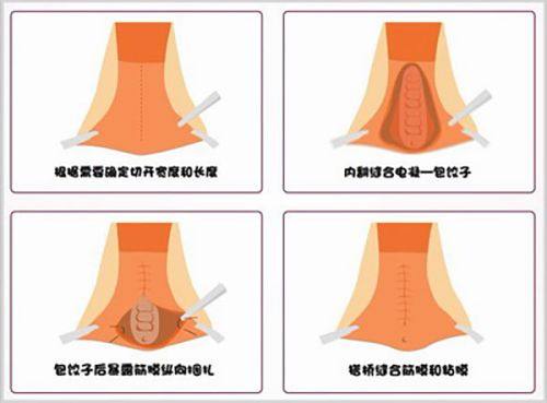 五、祛眼袋避坑指南：别让错误选择毁了“更好”成效