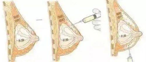 三、正确热敷的操作方法，让成效事半功倍