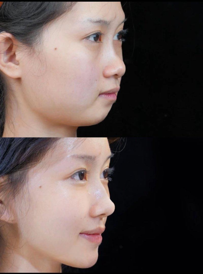 五、疤痕治疗的风险提示与疗程管理