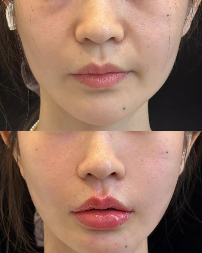 三、再生材料注射:长效自然的新型选择