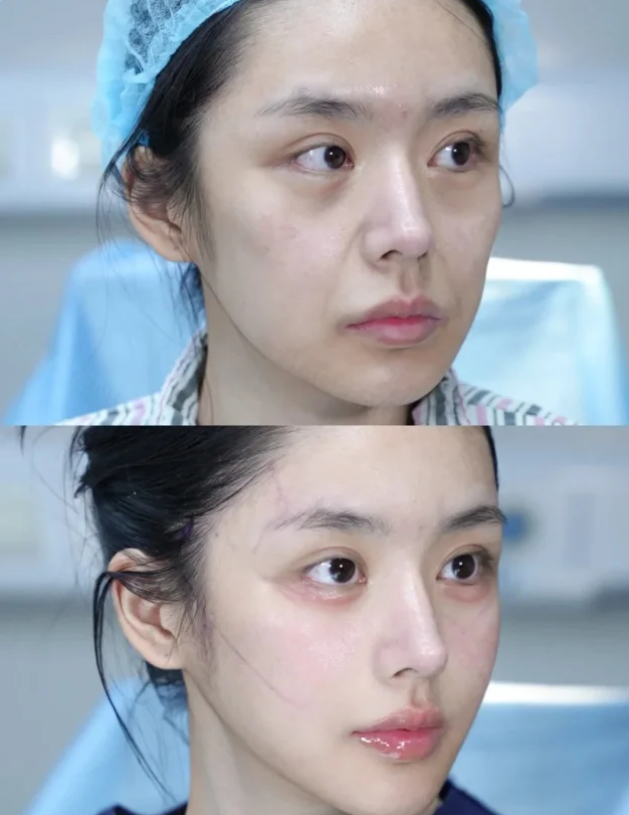 三、组织缺失型眉毛凹陷疤痕：疤痕精细化修复+自体脂肪填充联合改善