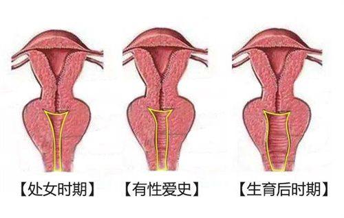 二、假体隆胸2年了还是特别硬，先明确核心原因：包膜挛缩