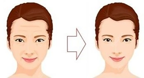 40多岁割双眼皮的核心优势：不止是变双，更能改善眼部松弛