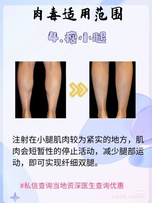 三、双眼皮术后疤痕增生会好吗