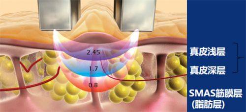 二、不同眼部基础的小眼睛，适配的双眼皮方案与成效