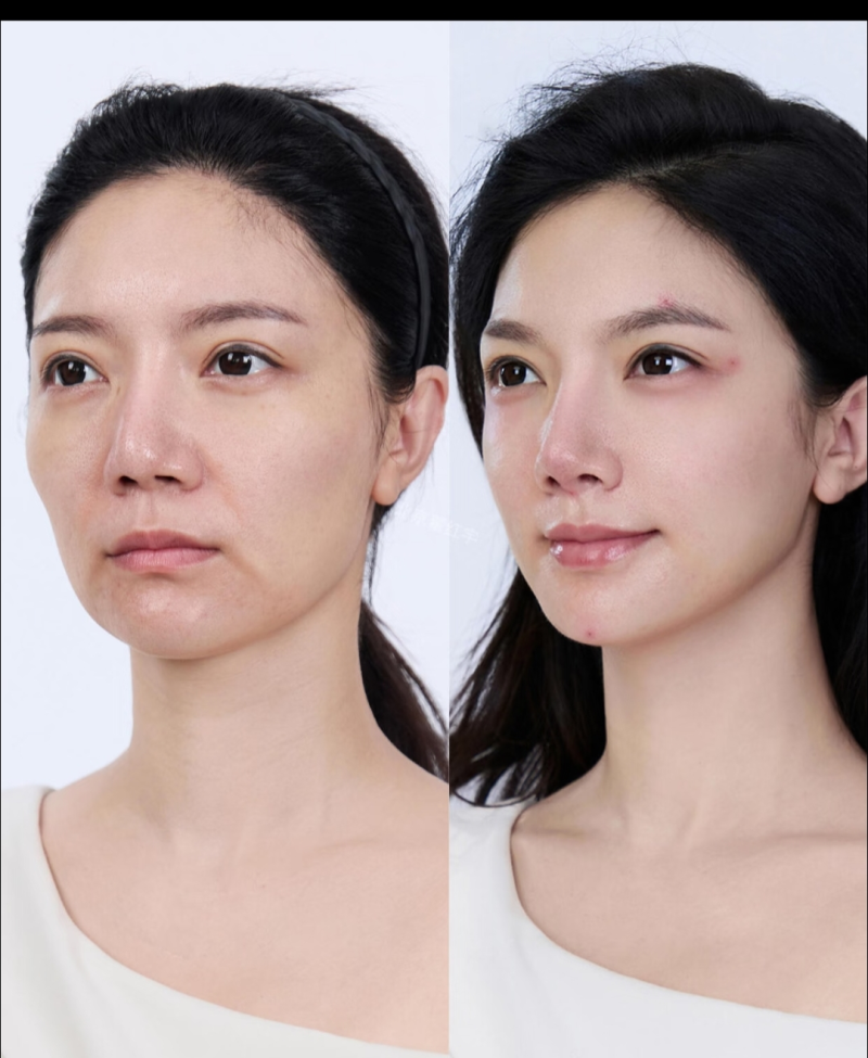 三、手臂抽脂多久可以做健身操、练瑜伽