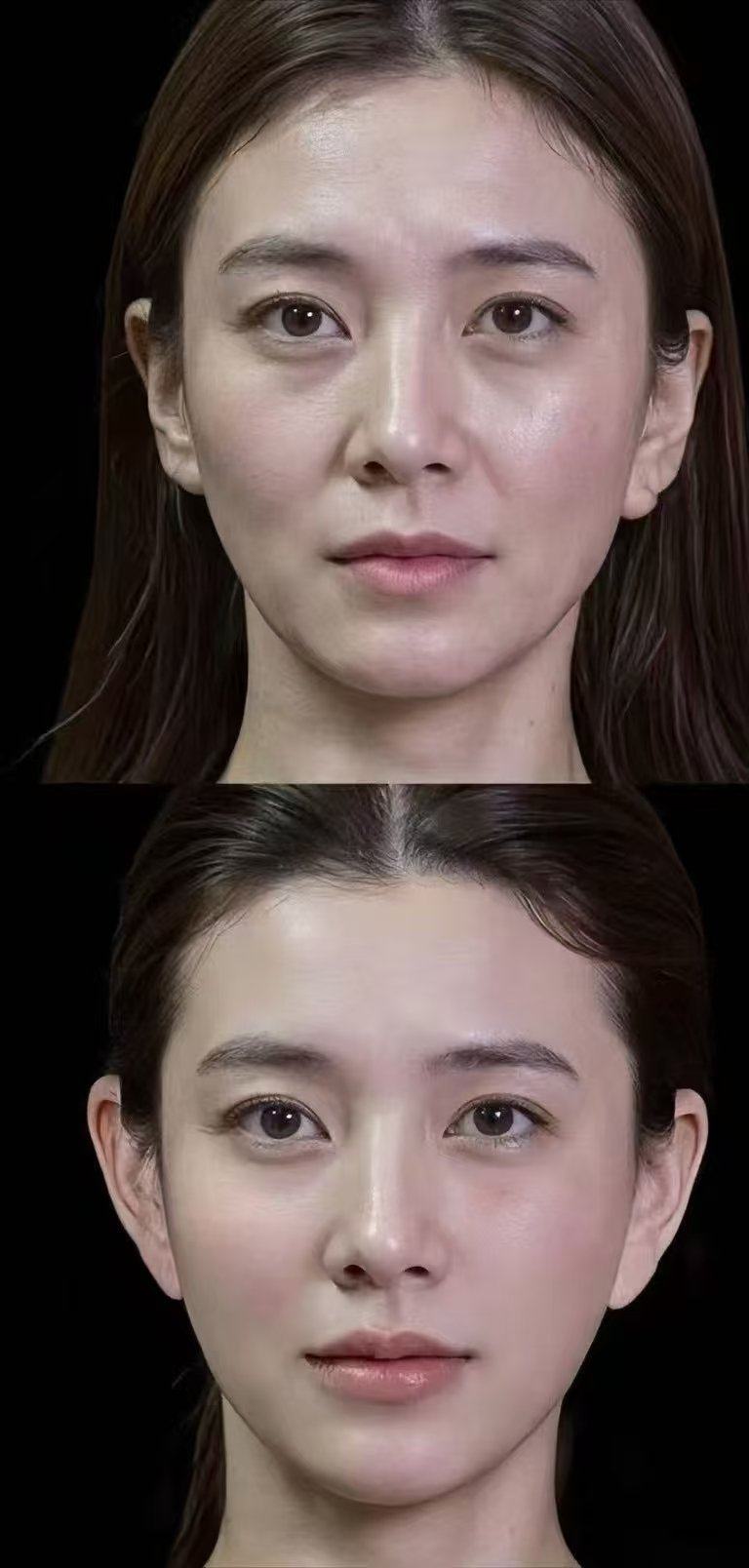 二、双眼皮疤痕增生能去掉吗