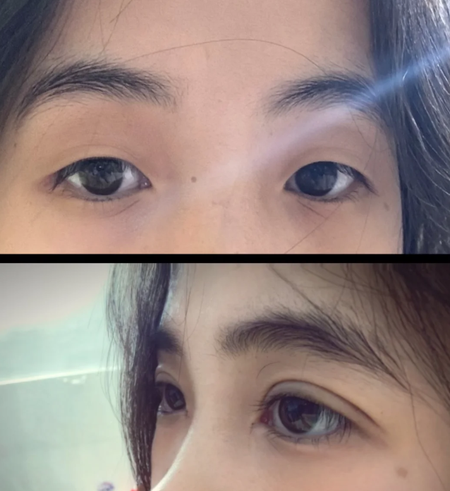 二、大腿抽脂一个月肿硬不消,科学应对方法看这里