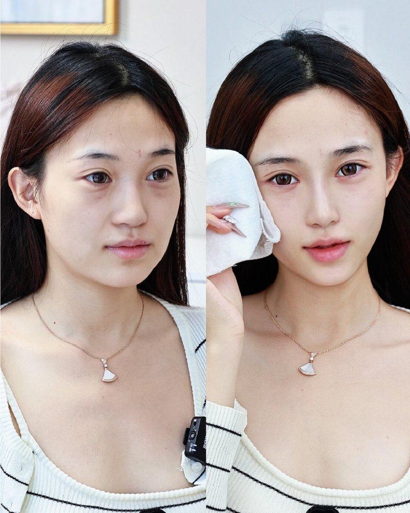 四、手臂抽脂多久可以跳绳、跑步