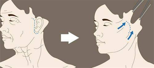 四、脸上凹疤痕怎样去掉——术后护理关键要点