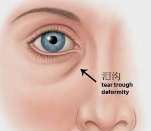 三、女生群体对眼霜去眼袋的常见误区