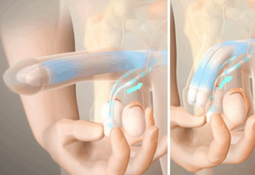 五、不同类型痘坑的医美修复方案参考