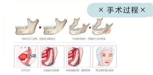 三、早期疤痕预防：伤口愈合后的抗疤干预