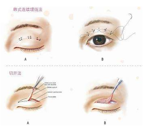 四、刀划伤留下疤怎么去除：后期修复手段