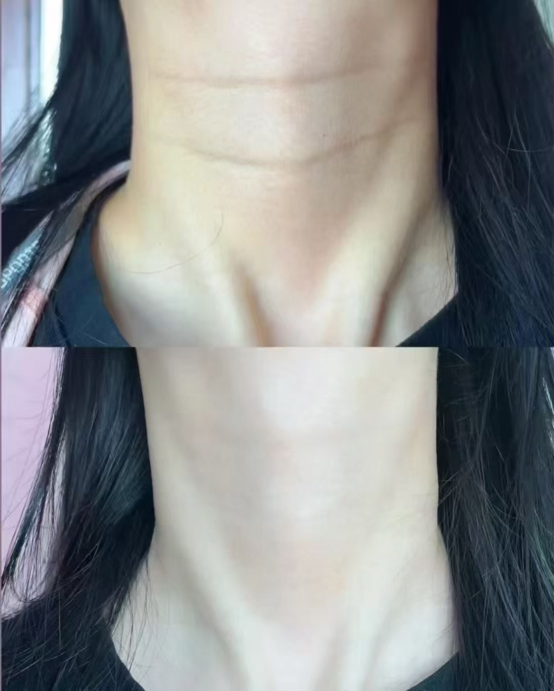 二、脸部有凹疤痕怎么办小妙招