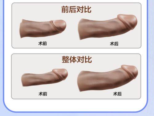 四、男士医美手术去眼袋方法：中重度眼袋的效率高解决方案