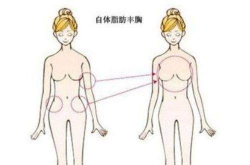 五、富贵包吸脂多久能修复？