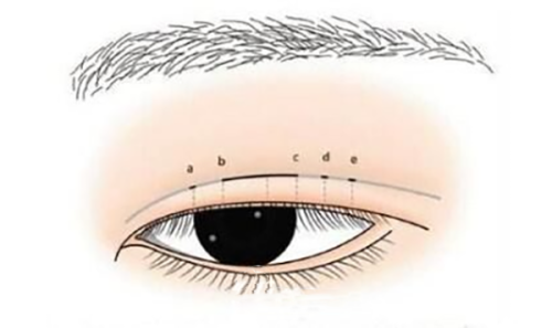 四、假体隆胸不够软怎么办？分阶段应对有妙招