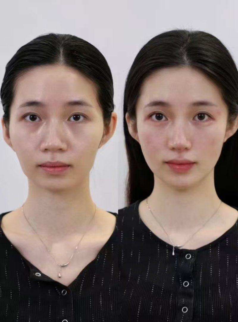 四、网传蜂蜜去眼袋的实用偏方解析