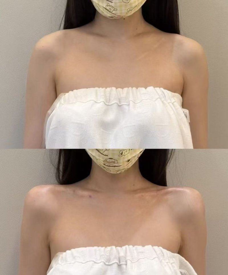 三、疤痕凝胶药膏的正确用法