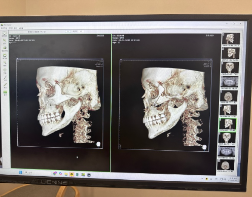 三、富贵包吸脂手术多少钱？