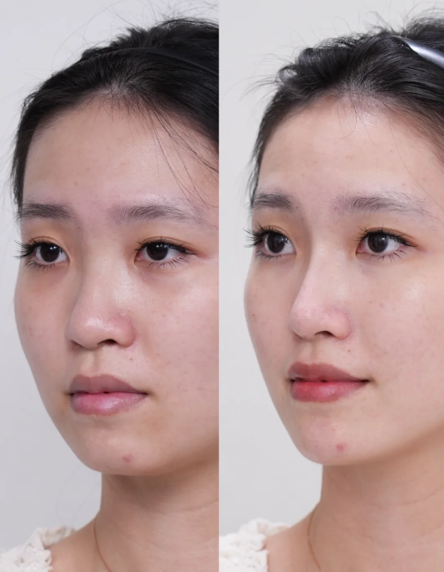 二、先辨清：你真的是疤痕体质吗