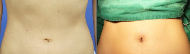 五、更科学的眼袋与皱纹改善方案