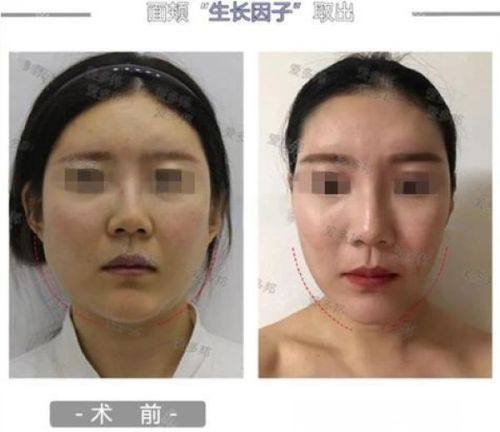 二、不同皱纹类型，怎么选除皱方法才效率高？