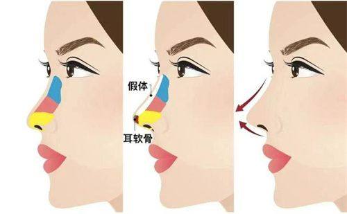 二、不同隆鼻术式的麻醉选择指南