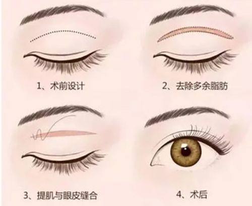 四、儿童天生上睑下垂的特殊应对方案