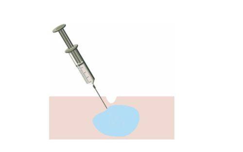 三、Plasma去疤的临床真实治疗经历参考