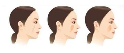 五、麻醉选择的关键沟通与术前准备