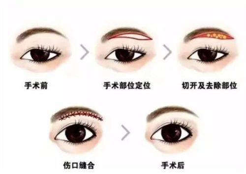 五、不同专精观点:理性看待假体终身留存