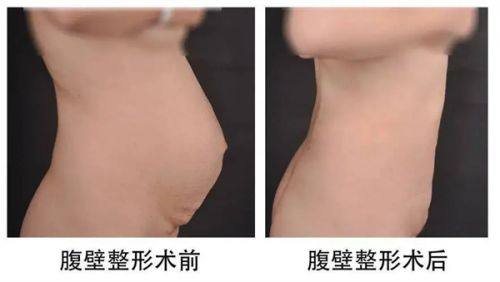 三、个人体质与耐受度对麻醉方式的影响