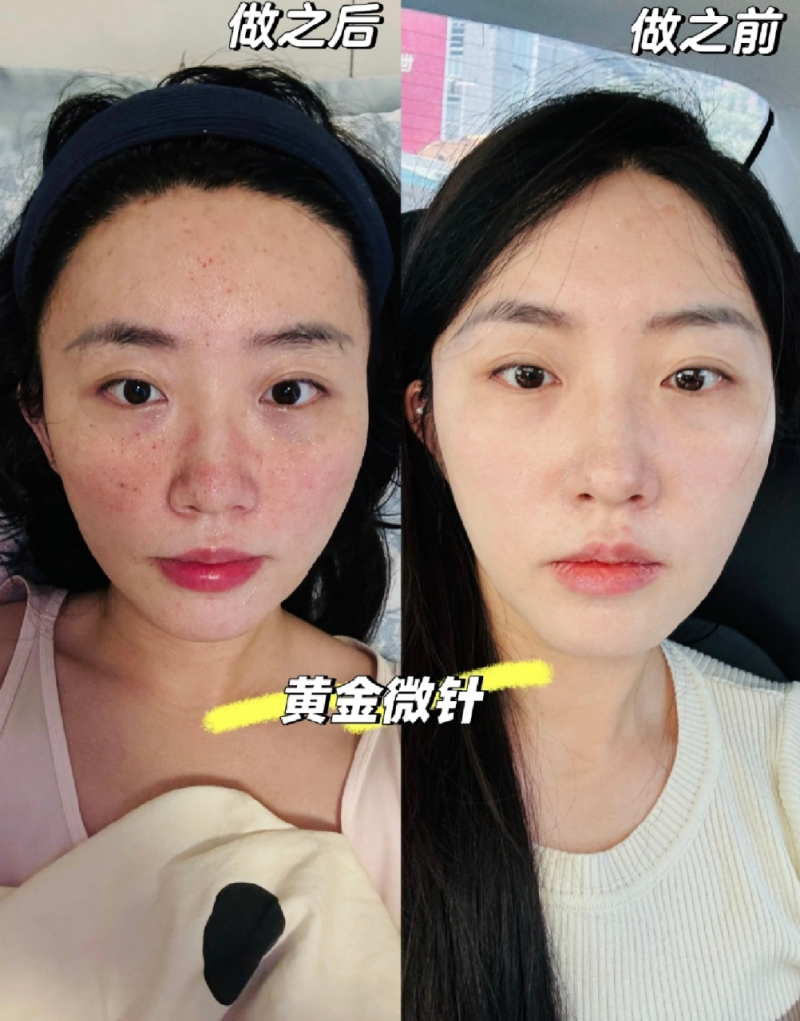 三、脸部除皱避坑小妙招，选对不踩雷