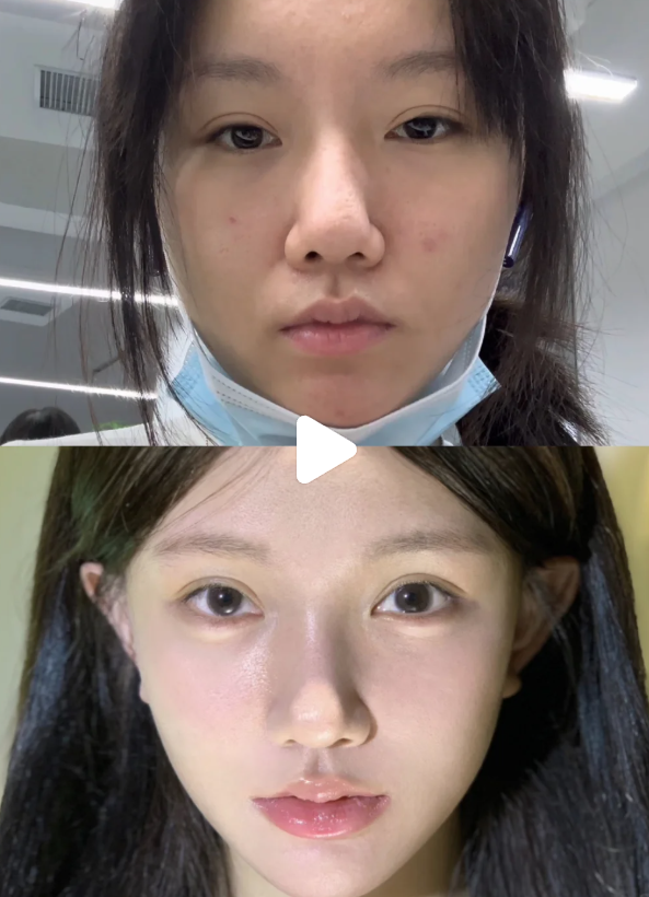 四、针对性医美方案，精细解决不同类型眼袋