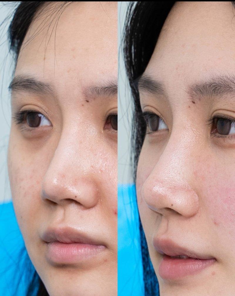 三、医生技术:直接影响假体长期稳定性