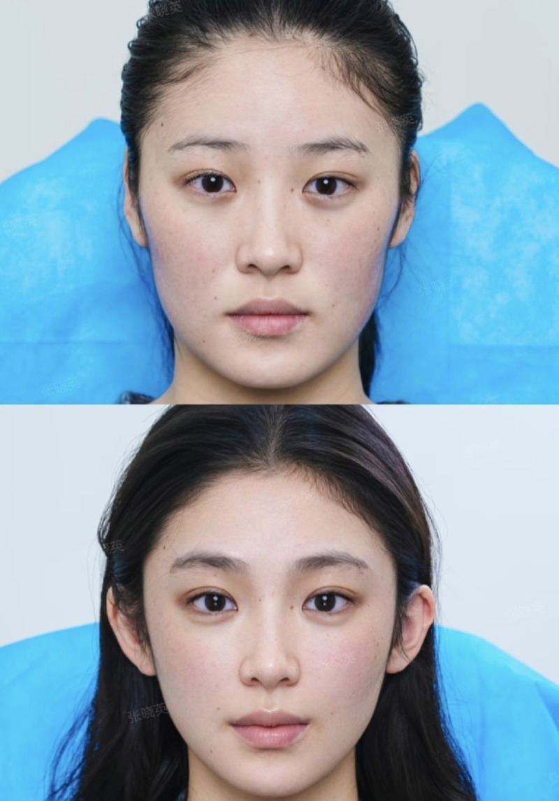 四、双眼皮宽改窄的成功几率与难度解析