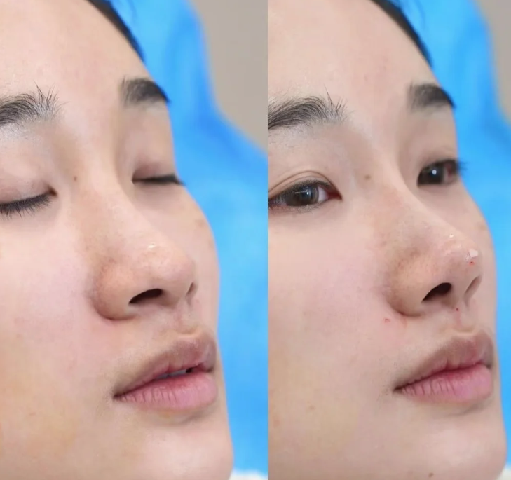 四、局麻vs全麻：从风险与体验看优先选择