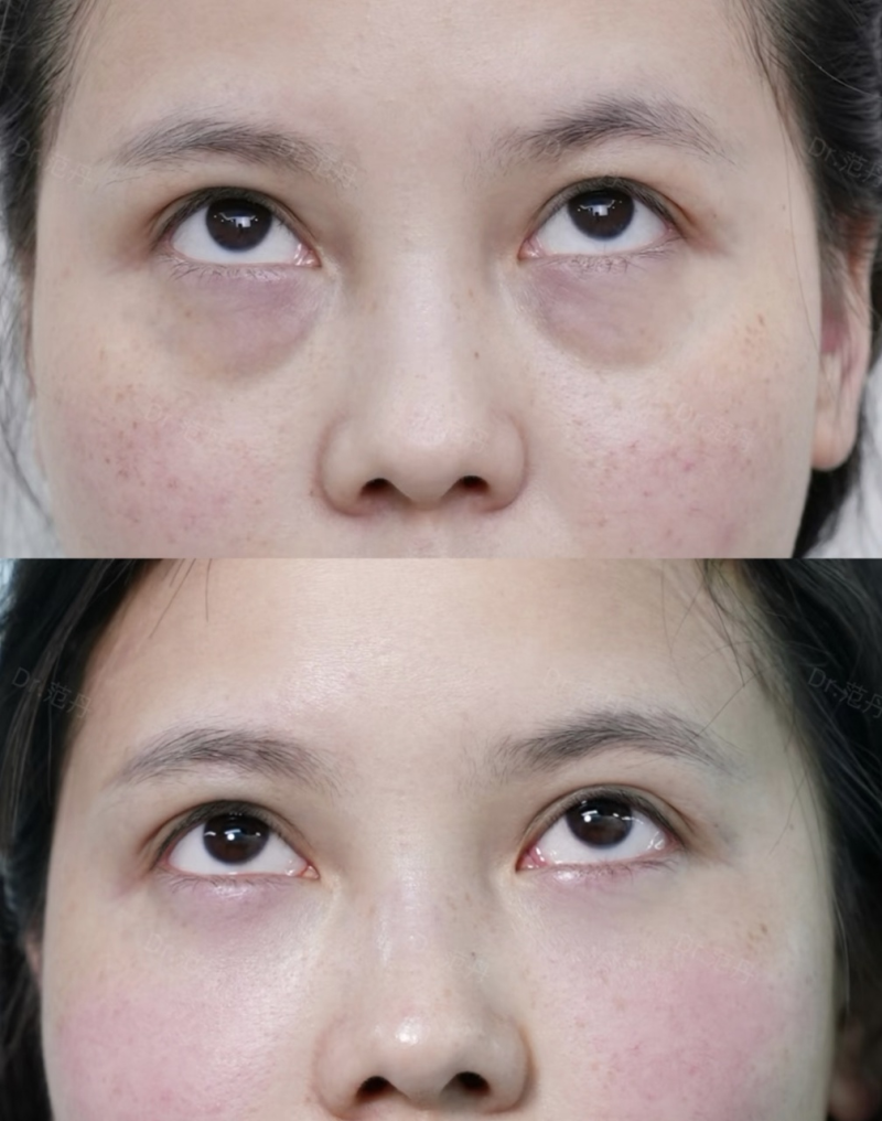 四、Plasma治疗增生疤痕的疗程与适用人群