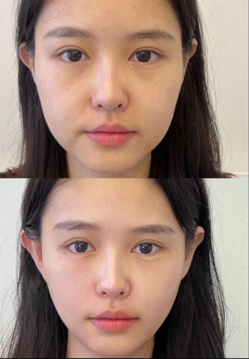 二、Plasma对凸起疤痕的祛疤成效解析