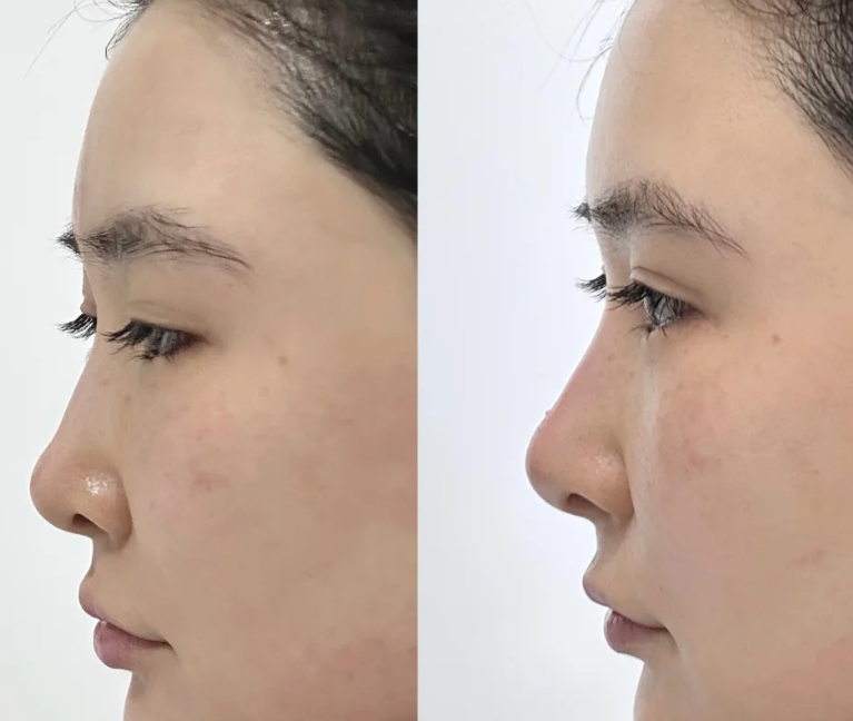 三、双眼皮宽改窄,到底要不要去皮?