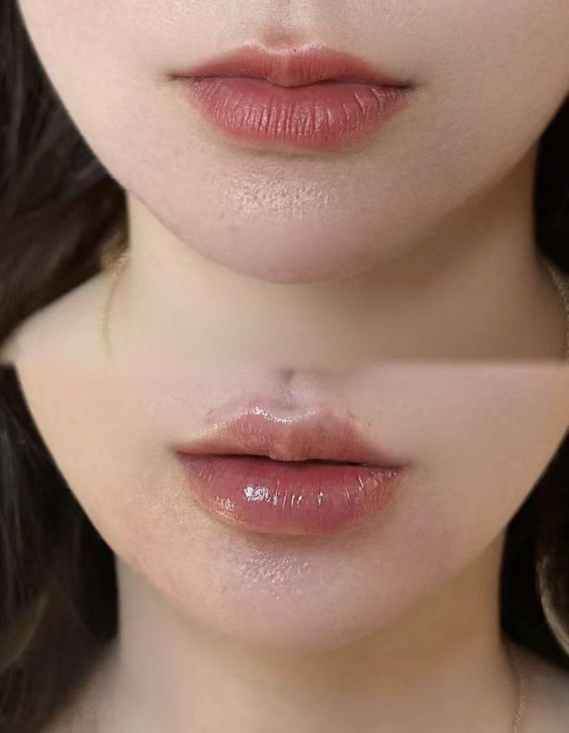 三、手术缝合类修复：深凹陷与陈年旧疤的根源解决