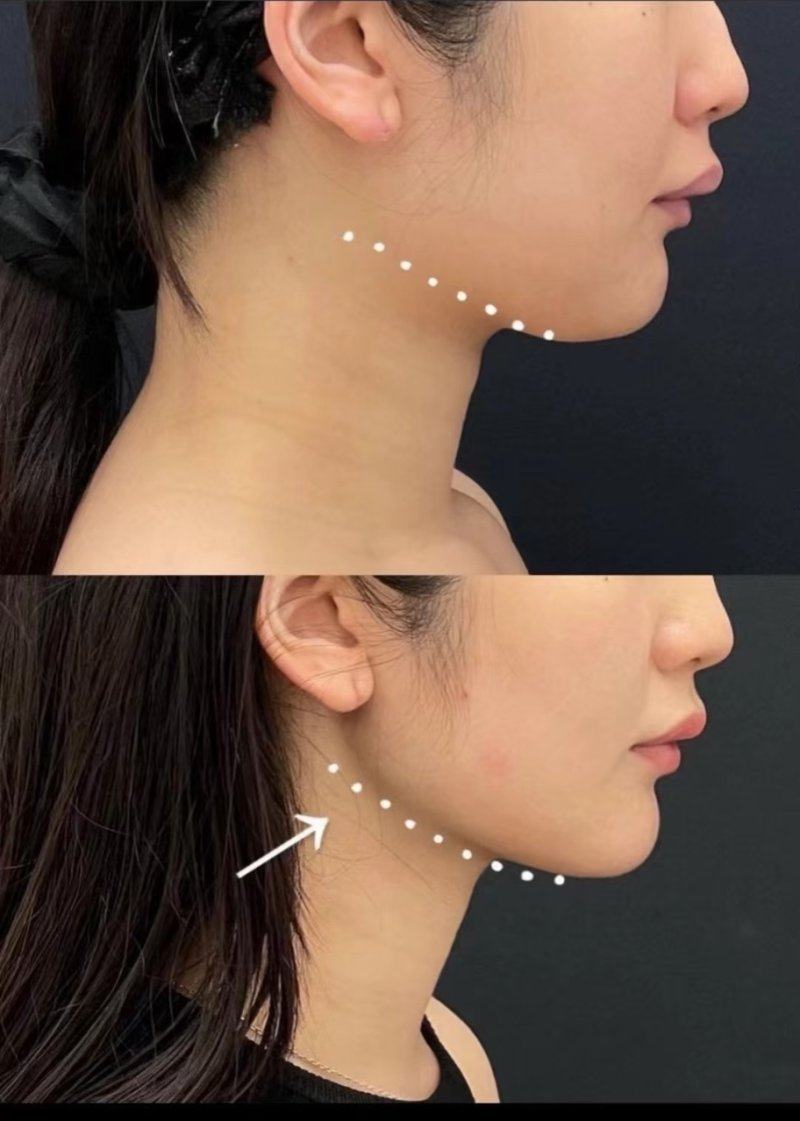 二、假体品质:决定能否终身留存的基础