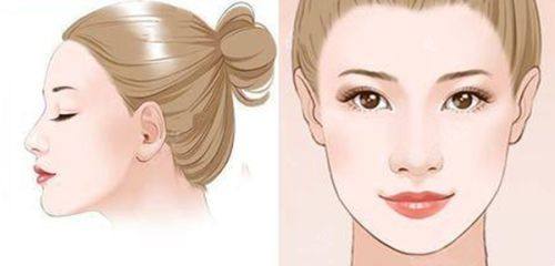 五、线提升隆鼻取出来能修复原样吗?分情况判断