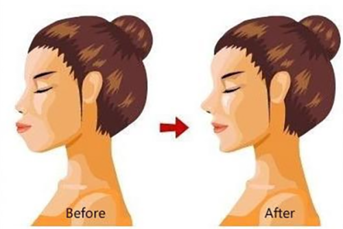 五、土豆能消除眼袋吗？真性眼袋需靠专精手段